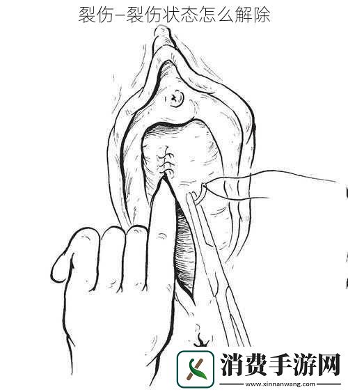 裂伤—裂伤状态怎么解除