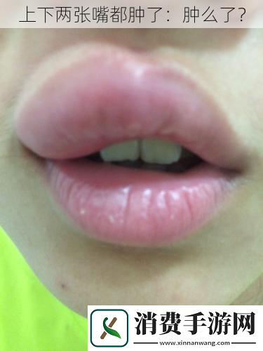 上下两张嘴都肿了