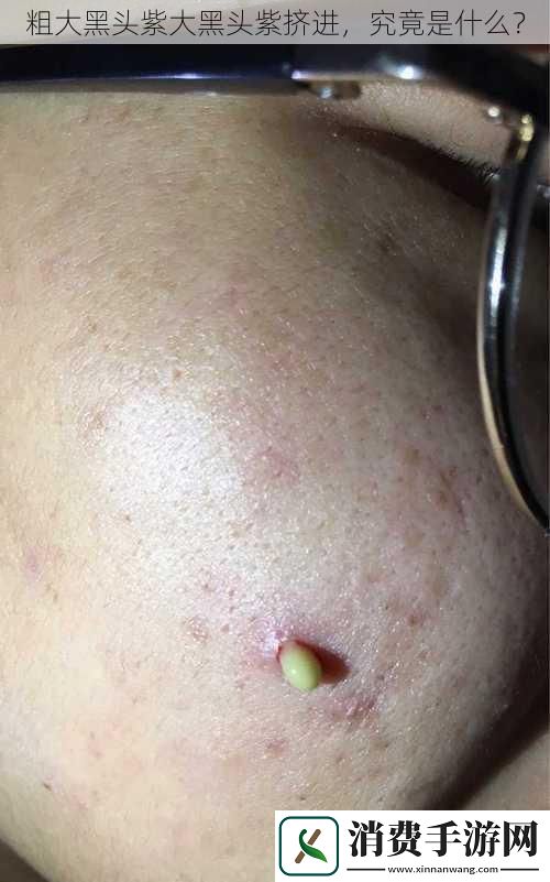 粗大黑头紫大黑头紫挤进究竟是什么