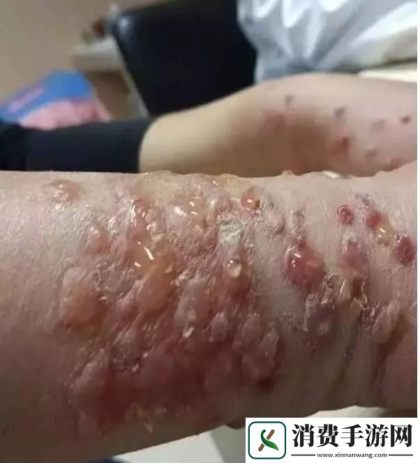 "皮下异物的奇妙漂流：科技界的趣味热议"
