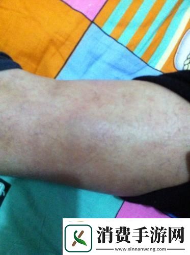 小腿异物创新热点下的尴尬“趣”事