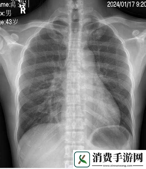 胸片全体曝光：探索人体奥秘的窗口