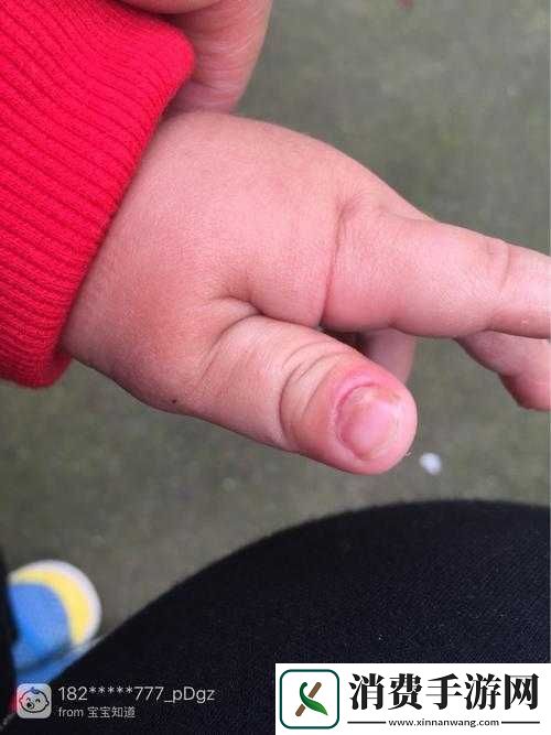 宝宝怎么才三根手指就痛