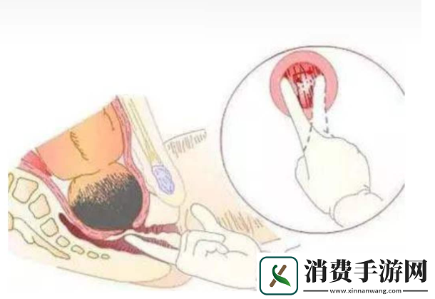 内检时医生手剥一圈引关注