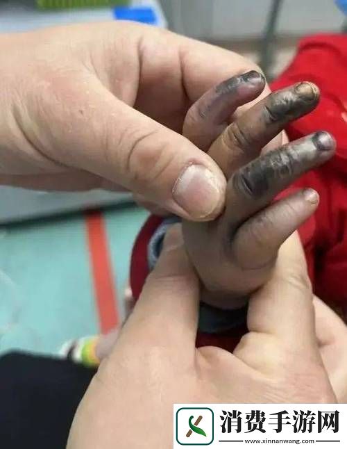 宝宝怎么才三根手指就痛